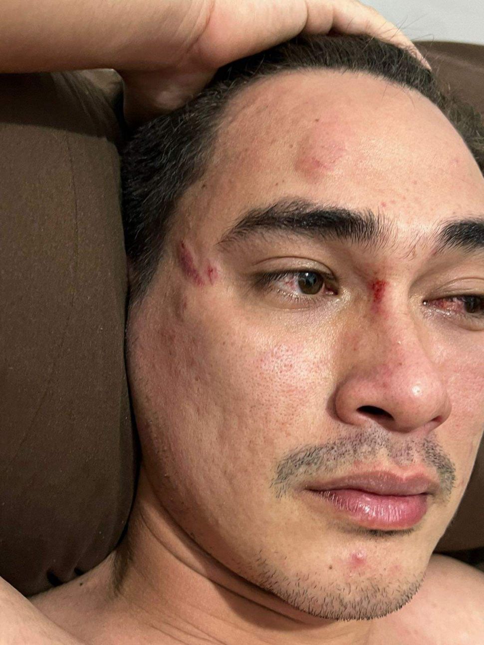 Rico Valentino mengalami luka di bagian wajah karena kasus pengeroyokan. [Instagram]